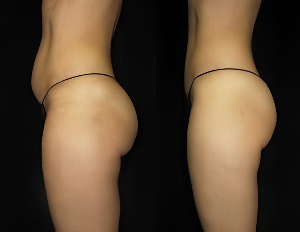 Body contouring before and after comparison